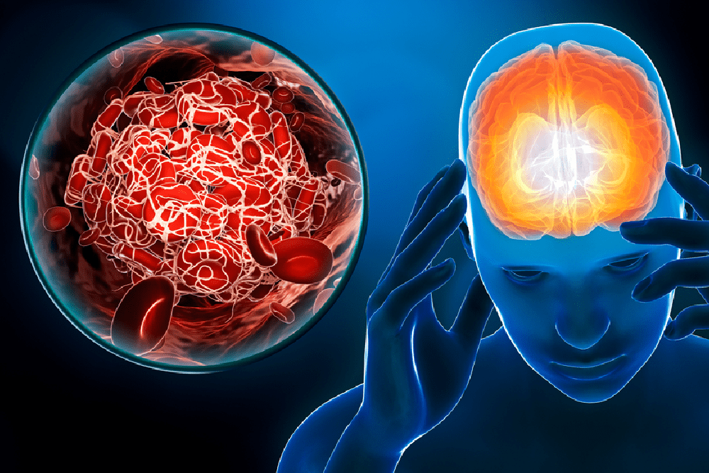Dra. Sunilda Vassallo 5 (Enfermedades Cerebro-vasculares)