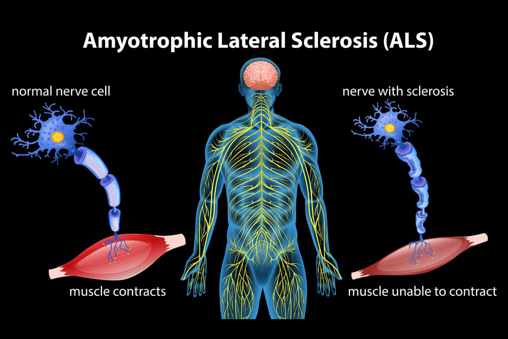 Dra. Sunilda Vassallo 11 (Enfermedades Musculares)