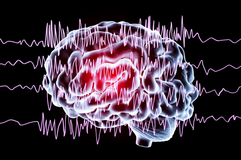Dra. Sunilda Vassallo 7 (Epilepsia)